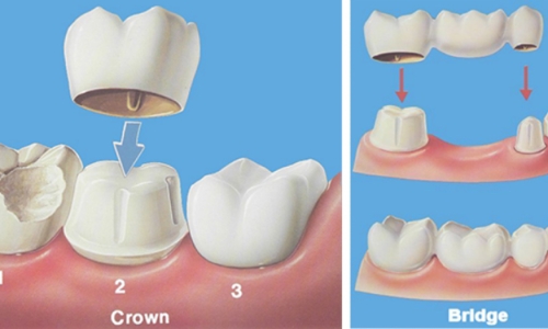 Fogkorona - fog pótlás